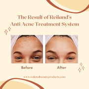 Reiland Acne Control System – 4 - Step Treatment for Clearer Skin - Reiland Beauty Products, LLC