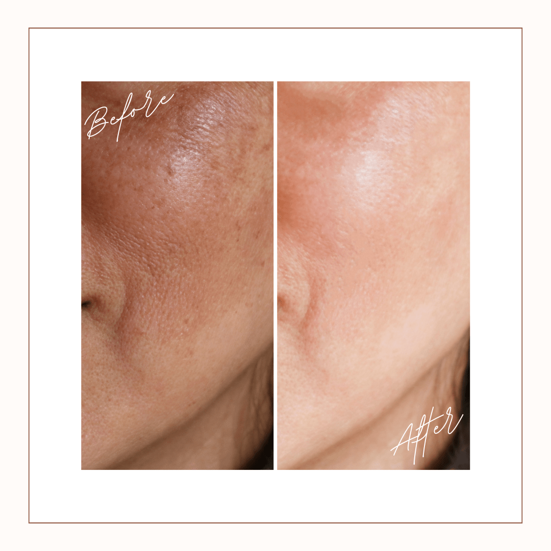 Close-up before and after of facial skin showing smoother texture and refined pores after consistent use of Reiland Luxury Exfoliating Facial Pads.