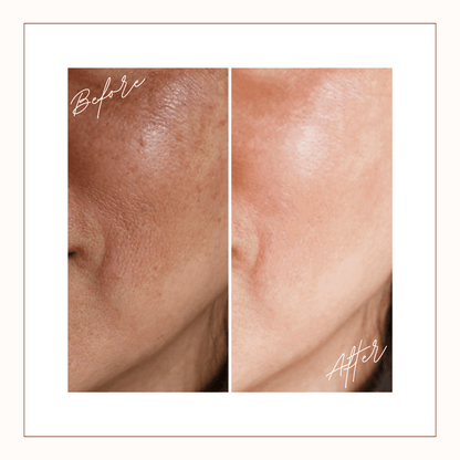 Close-up before and after of facial skin showing smoother texture and refined pores after consistent use of Reiland Luxury Exfoliating Facial Pads.