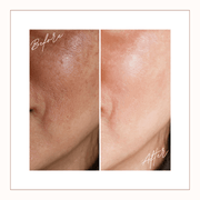 Close-up before and after of facial skin showing smoother texture and refined pores after consistent use of Reiland Luxury Exfoliating Facial Pads.
