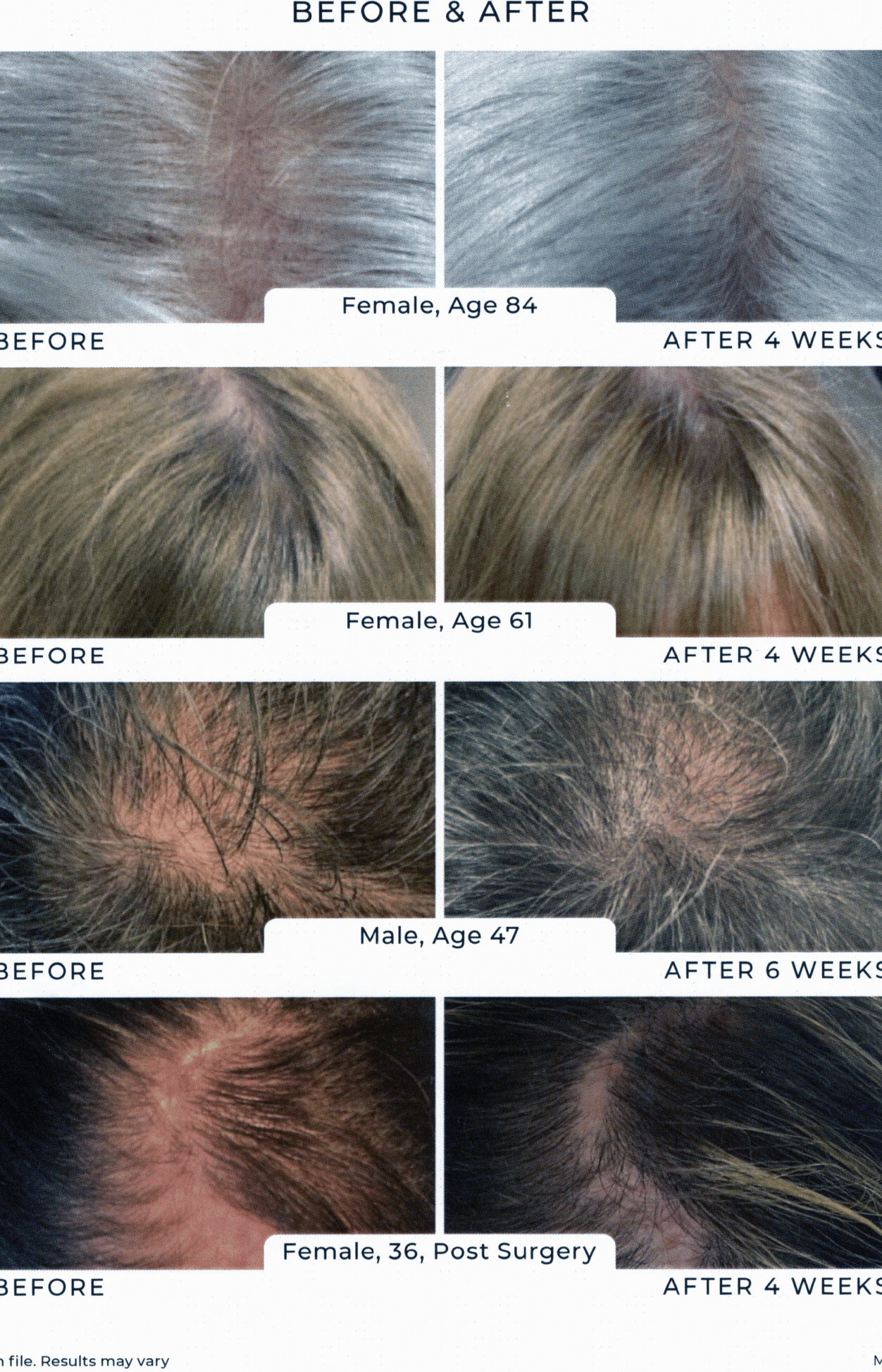 Before and after hair regrowth results from Reiland Advanced Hair & Scalp Shampoo. Visible improvement in scalp coverage and hair density shown in men and women aged 36 to 84 over 4 to 6 weeks.