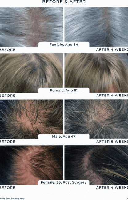 Before and after hair regrowth results from Reiland Advanced Hair & Scalp Shampoo. Visible improvement in scalp coverage and hair density shown in men and women aged 36 to 84 over 4 to 6 weeks.